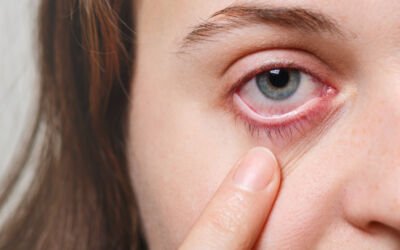Common Dry Eye Syndrome Treatment Options