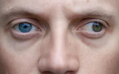 Strabismus