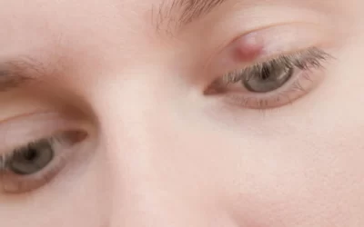 Styes