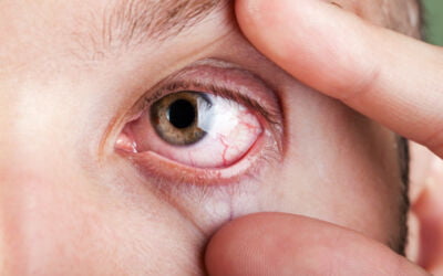 Dry eye